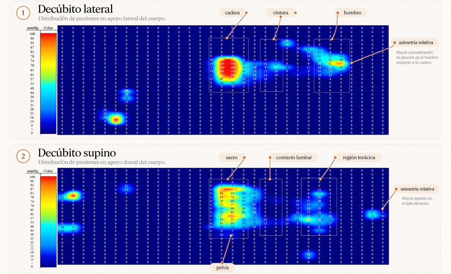 Ejemplo de distribución de presiones registrada durante una Pressure Mapping Session de Oniric